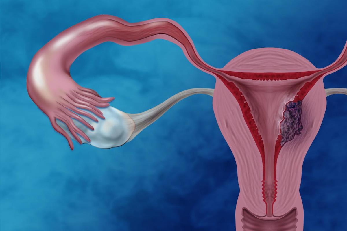 endometriosis around colon